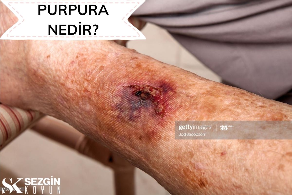 Purpura Nedir? – Tanım, Nedenleri ve Tedavisi